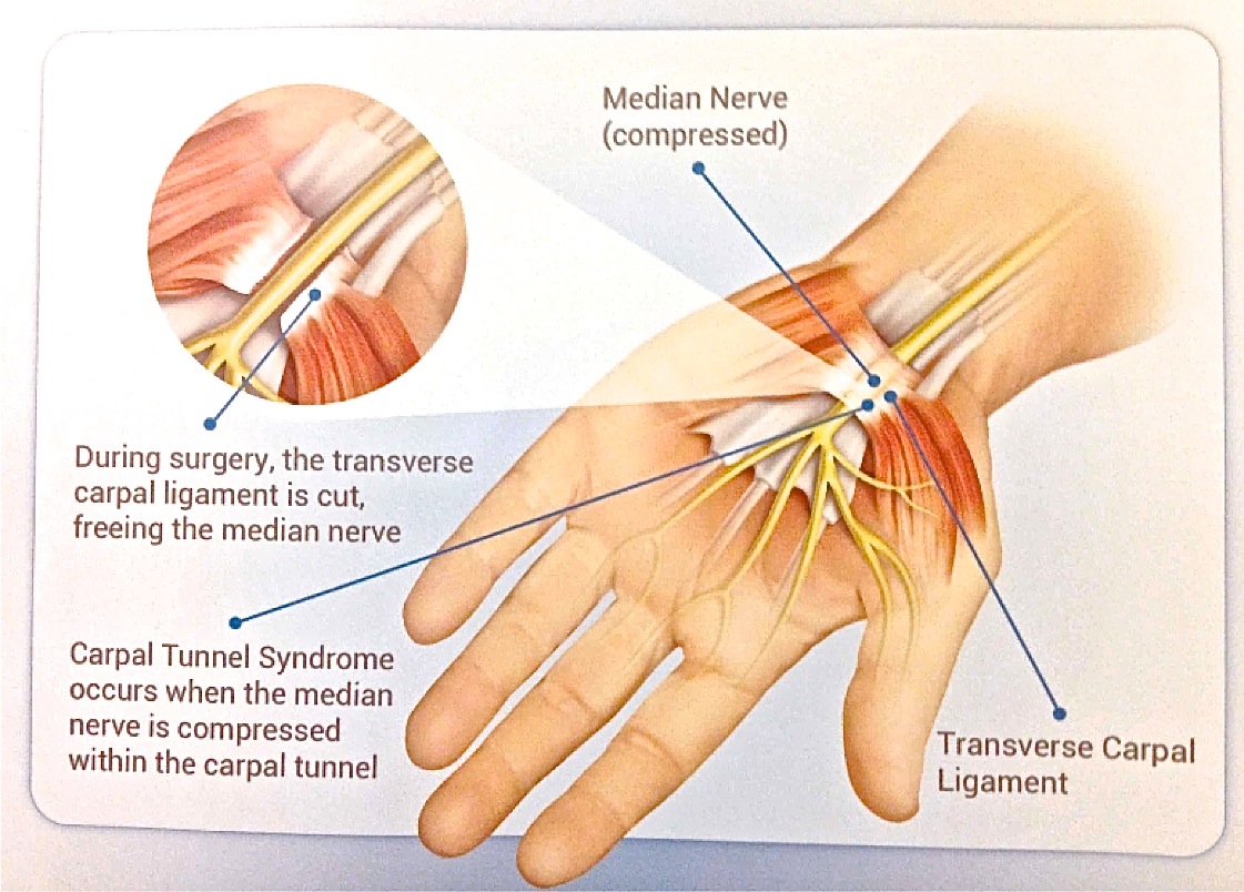 Carpal Tunnel Syndrome Surgery: Purpose, Procedure, Benefits and
